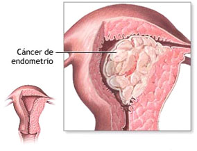 endometrial cancer in colon)