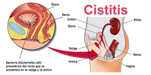 Comprar CISTITIS