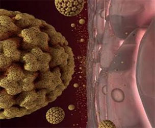 papilloma cancer risk veruci genitale decât îndepărtați