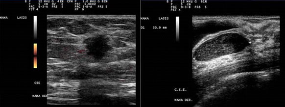 papiloma intraductal ecografia hpv red skin