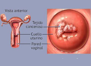 virus del papiloma en mujeres